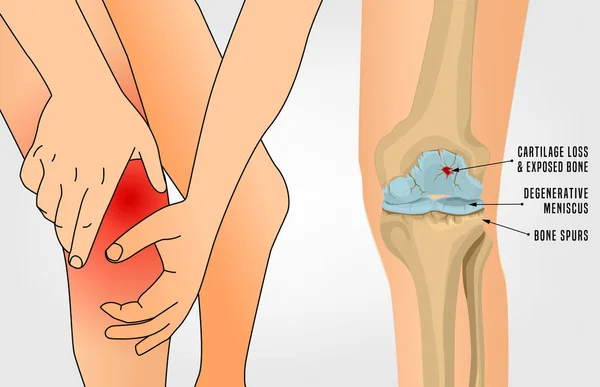 Choroby Zwyrodnieniowej Stawu Kolanowego Ilustracja Wektorowa Edycji Szczegółowy Realistyczny Styl — Wektor stockowy