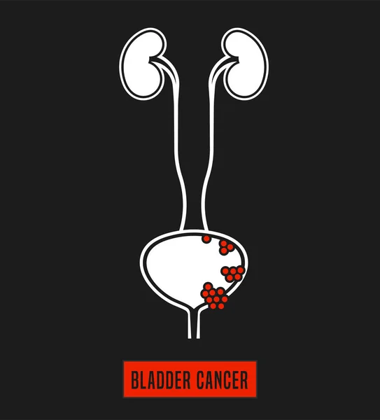 Ícono del cáncer de vejiga — Vector de stock