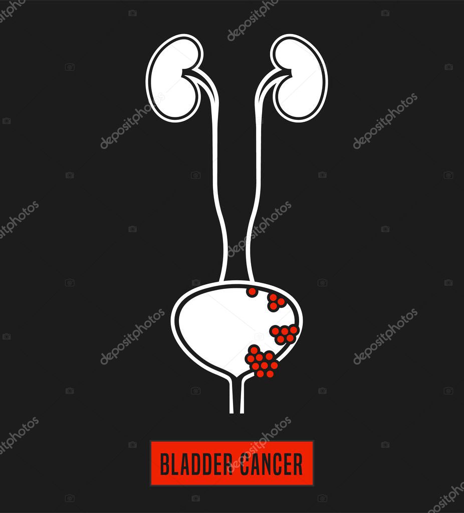 Bladder cancer pictogram. Urology medical icon in white and red color. Prostate cancer awareness month. Health logo. Editable vector illustration in flat style isolated on a dark grey background.