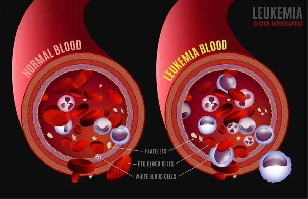 Leucémie infographie médicale — Image vectorielle