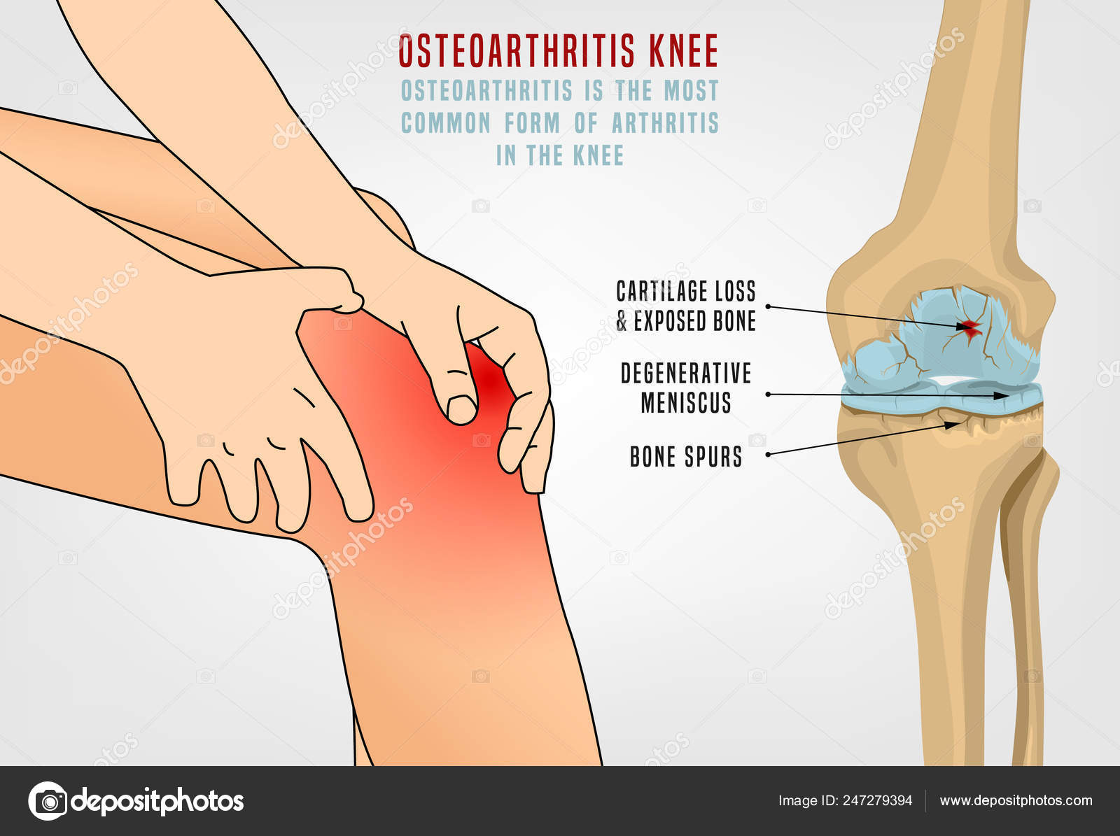 6 szokatlan ok, ami az osteoarthritis fájdalmát súlyosbíthatja