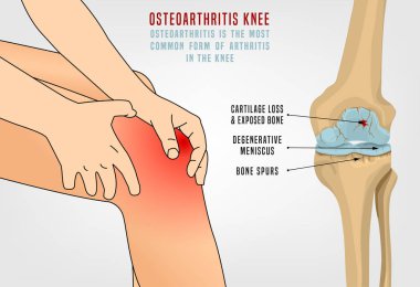 Osteoartrit diz Poster
