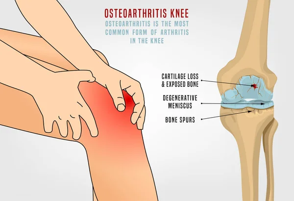 Osteoartritis Rodilla Poster — Vector de stock