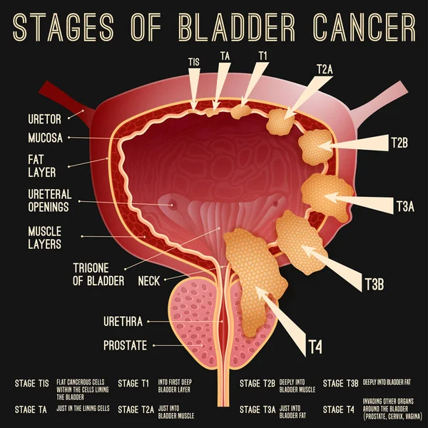 Bladder cancer stages — Stock Vector