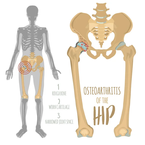 Osteoartritis de cadera Imagen — Vector de stock