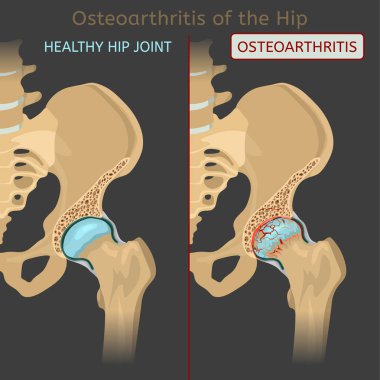 Hip Osteoarthritis Image clipart