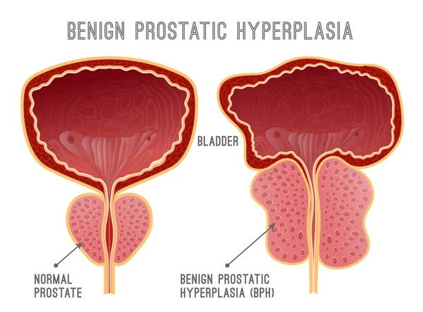 Prostate ziekte Infographic — Stockvector