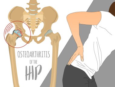 Kalça osteoartriti Infographic