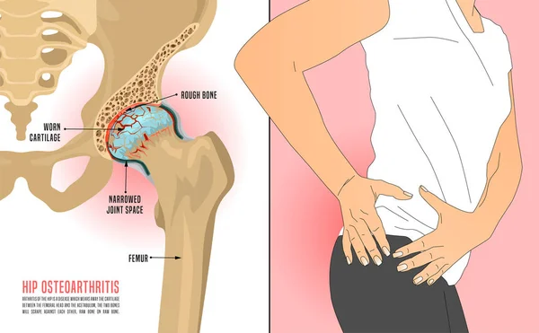 Osteoartritis de cadera Figura — Foto de Stock