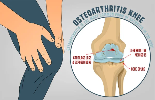 Cartaz de joelho de osteoartrite —  Vetores de Stock