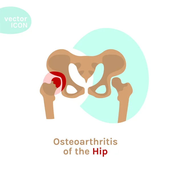 Csípő osteoarthritis ikon — Stock Vector