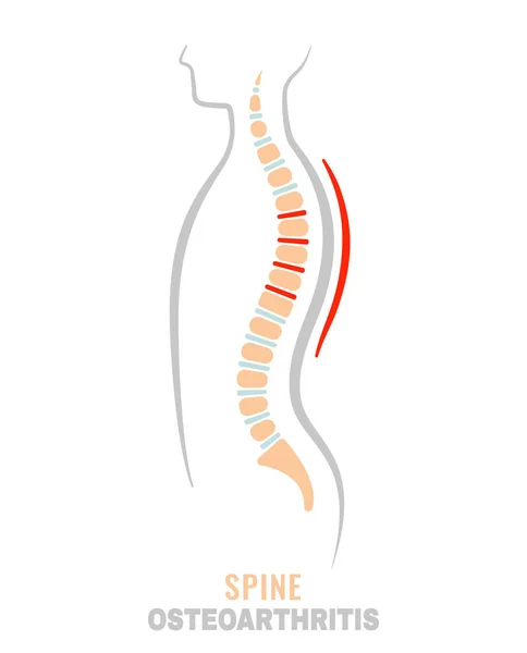 Icono de osteoartritis de columna — Archivo Imágenes Vectoriales