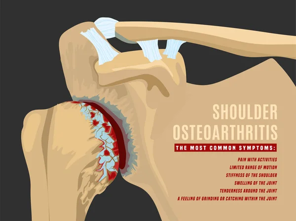 Infografía de la artritis de hombro — Vector de stock