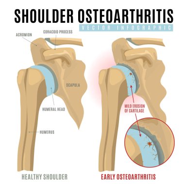 Omuz osteoartriti infografik