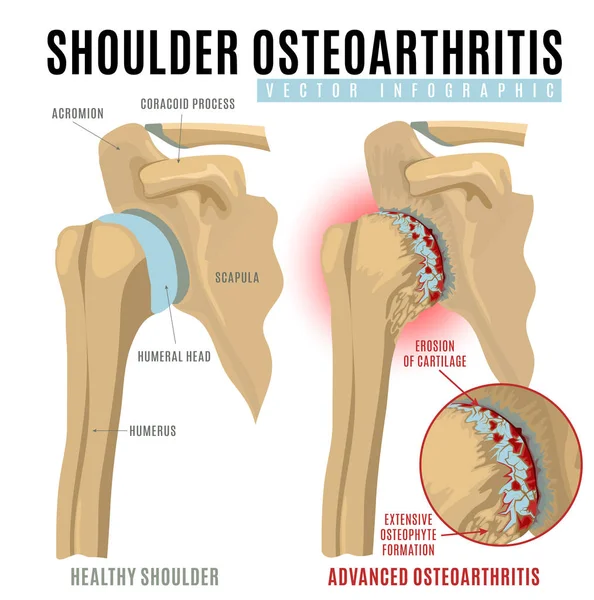 Shoulder osteoarthritis infographic — Stock Vector