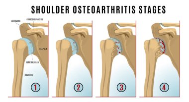 Omuz osteoartriti infografik