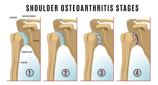 Infografía de la osteoartritis de hombro — Vector de stock