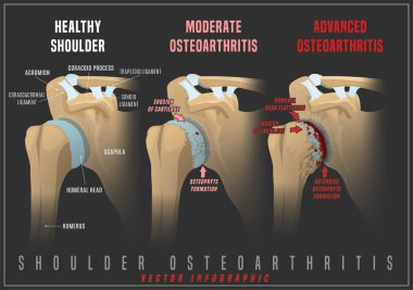 Omuz osteoartriti infografik