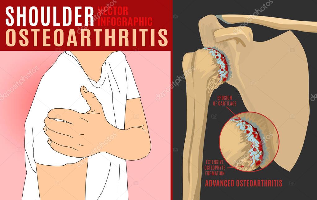 Shoulder osteoarthritis infographic.