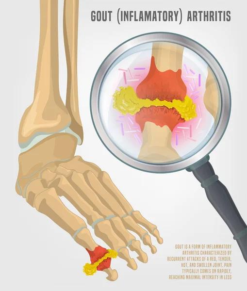 Gota artritis imagen — Vector de stock
