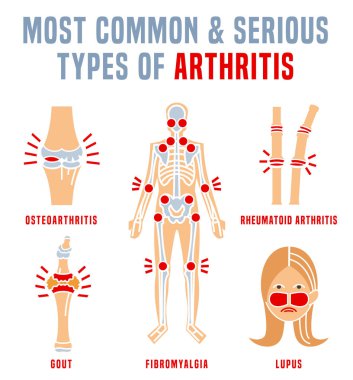 Artrit tipleri infografik