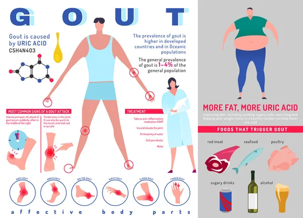 Infografika Gout arritis — Stockový vektor