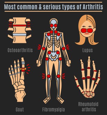 Artrit tipleri infografik