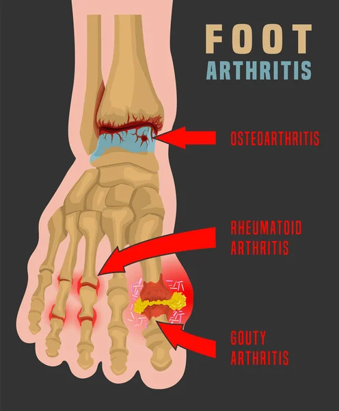Infográfico da artrite do pé —  Vetores de Stock