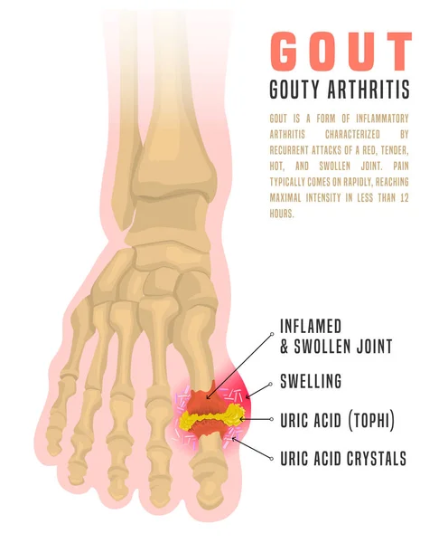 Infográfico da artrite de gota —  Vetores de Stock