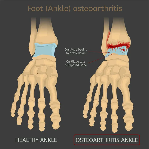 Bild der Fußarthritis — Stockvektor