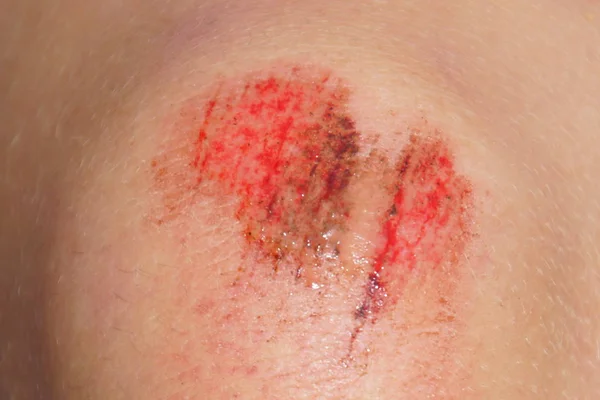 Close up of a partly infected knee wound.