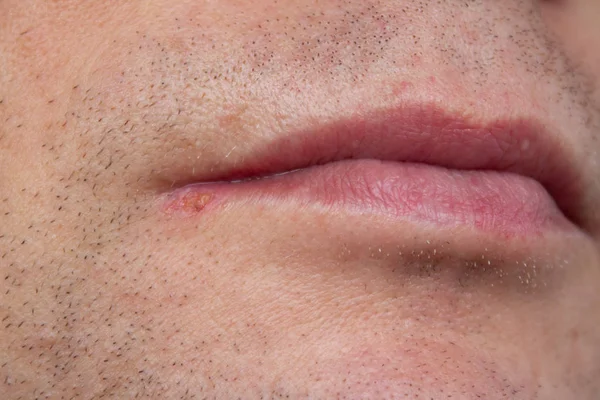 Mannen läppar virusinfekterade herpes — Stockfoto