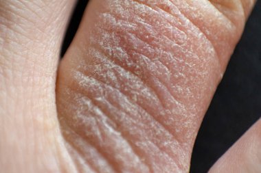 Hand dermatitis. Finger eczema clipart