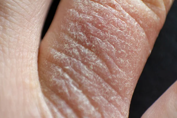 Hand dermatitis. Finger eczema — Stock Photo, Image