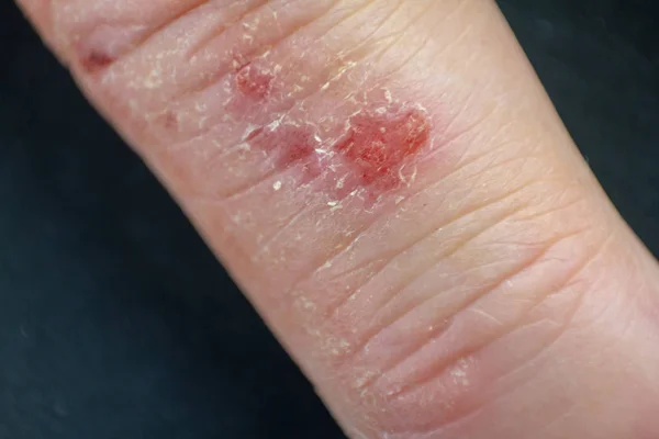 Hand dermatitis. Finger eczema — Stock Photo, Image