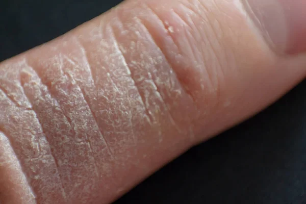 手の皮膚炎。指のアトピー性皮膚炎 — ストック写真
