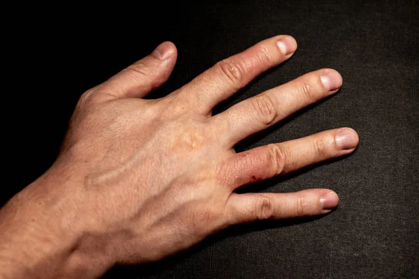 Hand dermatit. Finger eksem — Stockfoto