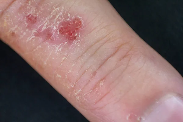 Dermatite das mãos. eczema dos dedos — Fotografia de Stock