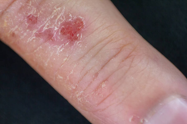 Hand dermatitis. Finger eczema