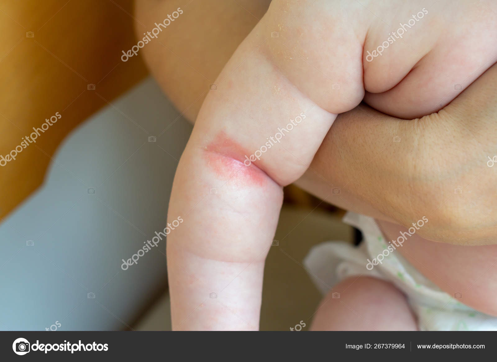Prickly Heat. Close-Up Of The Folds Of The Hand Of A Newborn Baby.