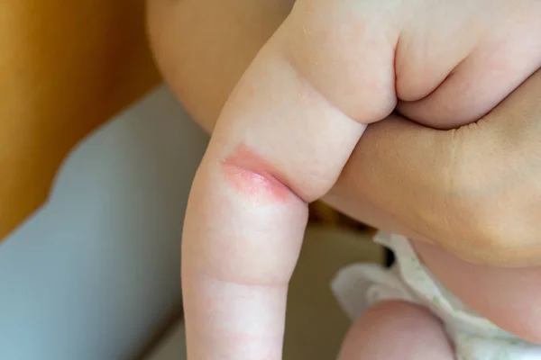 Prickly heat. Close-up of the folds of the hand of a newborn baby with red skin. — Stock Photo, Image