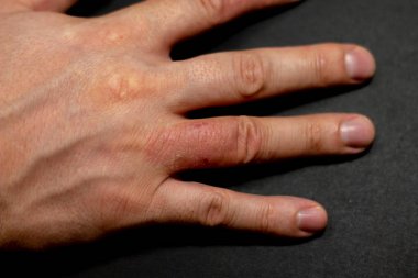 Siyah arka planda el dermatitis egzama. 