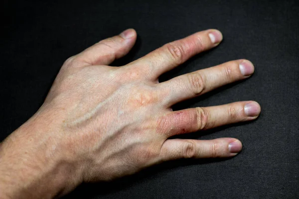 Hand dermatitis eczema on black background. — Stock Photo, Image