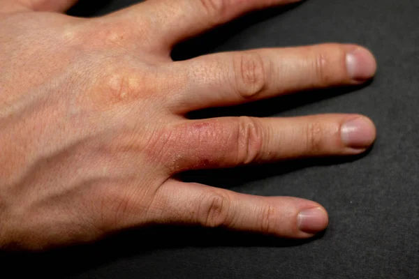 Dermatite della mano eczema su sfondo nero . — Foto Stock