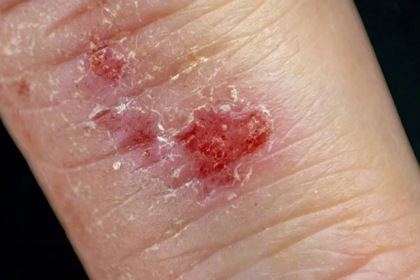 Hand dermatit eksem på svart bakgrund. — Stockfoto