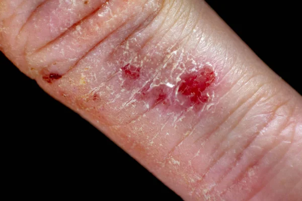Hand dermatitis eczema on black background. — Stock Photo, Image