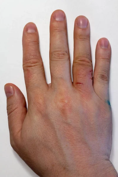 Hand dermatit. Handeksem stängd på vit bakgrund. — Stockfoto