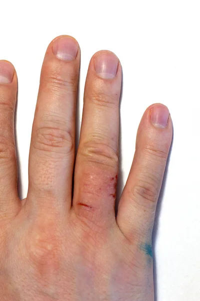 Hand dermatit. Handeksem stängd på vit bakgrund. — Stockfoto
