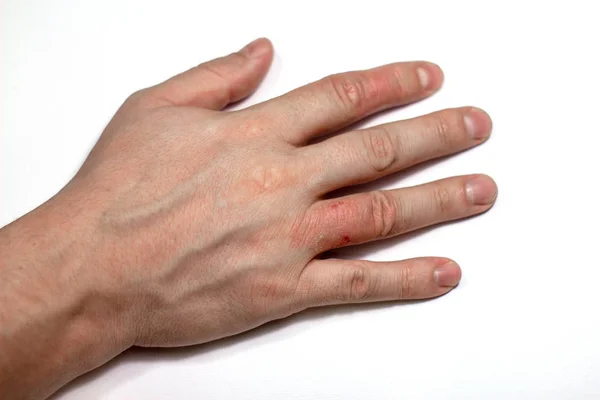 Hand dermatit. Handeksem stängd på vit bakgrund. — Stockfoto