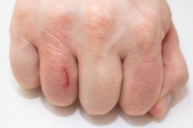 El dermatiti. El egzaması beyaz arka planda kapalı. Deri iltihabı cilt iltihabıdır.